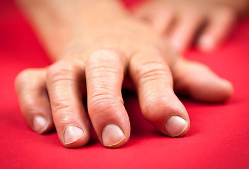 Rheumatoid arthritis causes painful swelling that can lead to permanent joint damage.